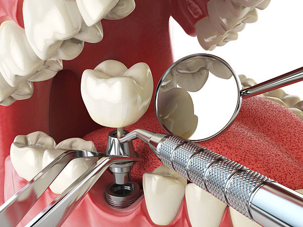 Best Emergency Tooth Extraction in Cuyahoga Falls, OH